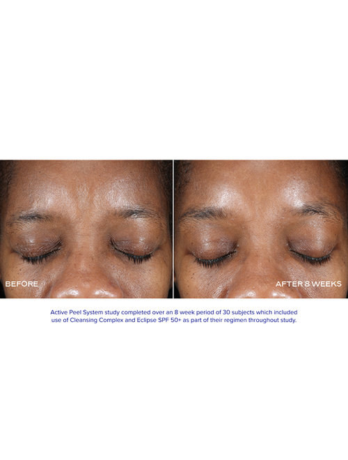 Extra Strength Active Peel Brightening System